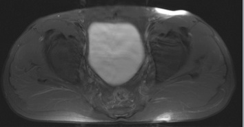 Figure 3 for case Hidradenitis suppurativa